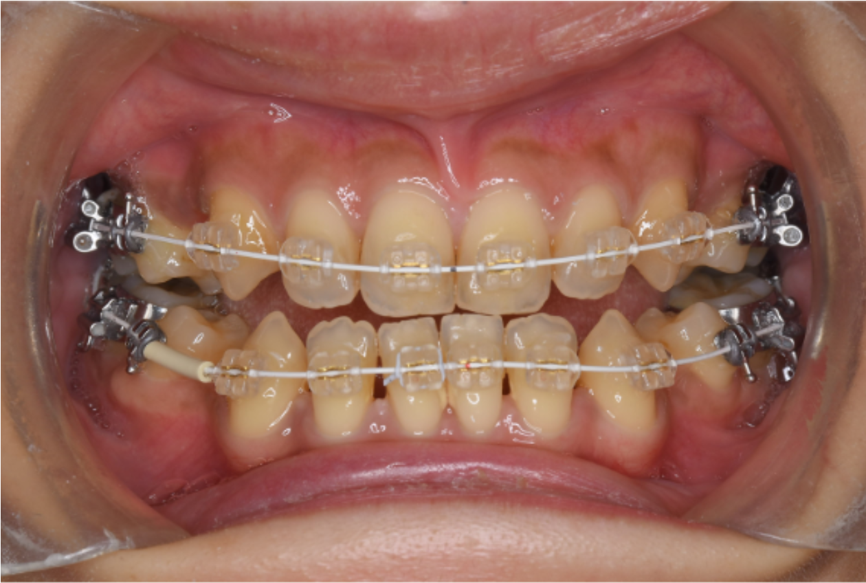 クリアブラケットとホワイトワイヤー装着時の口腔内写真