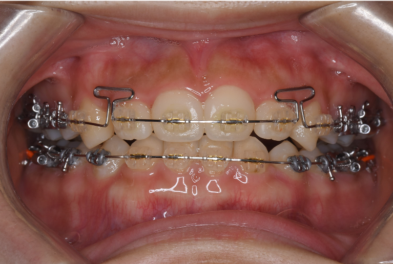 クリアブラケット装着時の口腔内写真