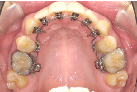 リンガルブラケット装着時の上顎の口腔内写真