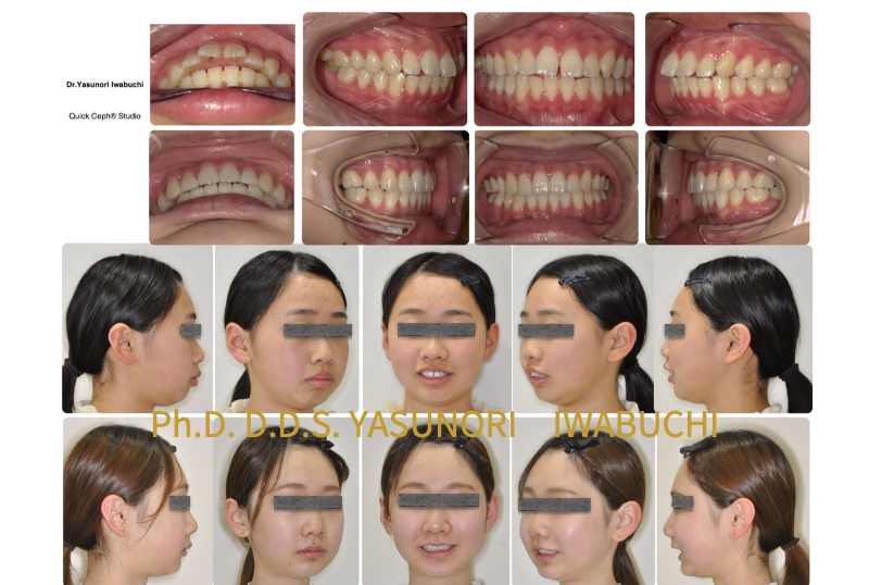 エラの張りと顔貌の非対称性が改善し、口ゴボが改善しオトガイが前方に出ている顔貌改善の比較写真と、歯列矯正前後の比較写真
