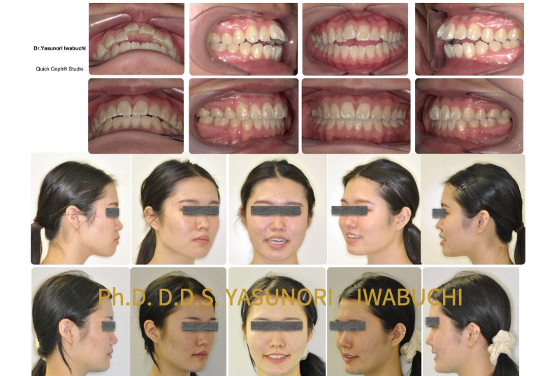 顔面の非対称性と口角の非対称性が改善している。スマイル時の前歯の露出が適切になった。顔貌の治療前後比較写真と歯列の治療前後比較写真
