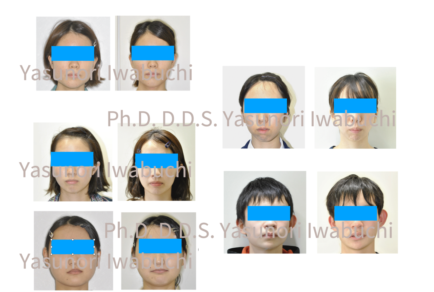 スプリント治療による５症例分の顔貌の変化写真